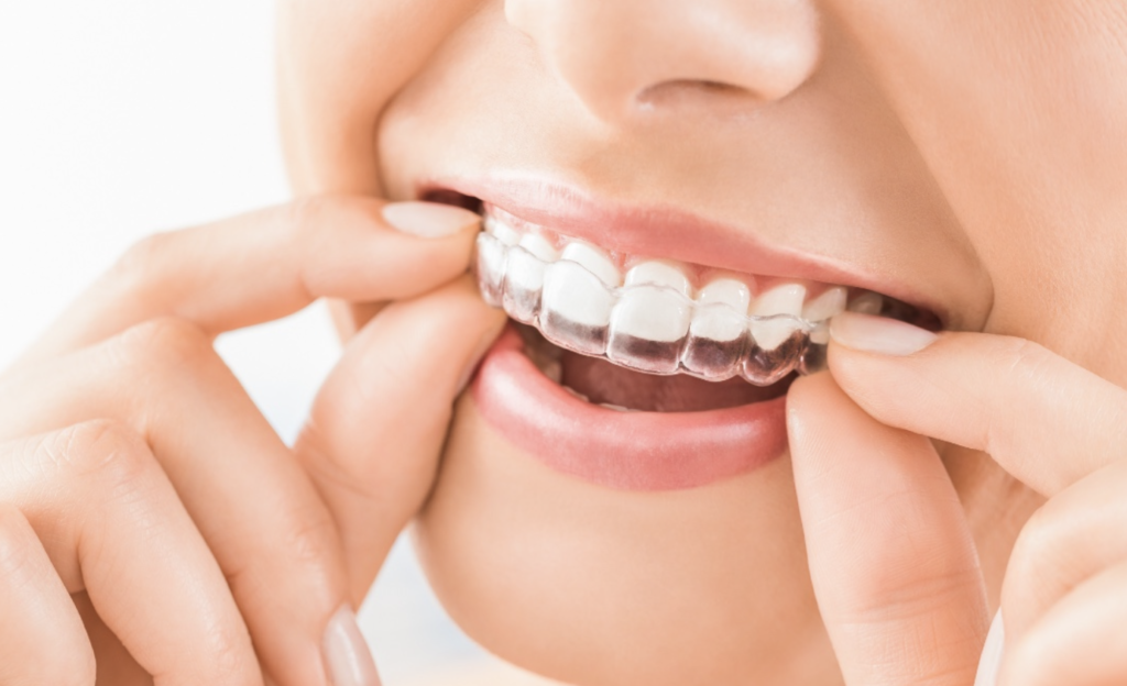 Sorriso perfetto: scegli l’apparecchio ortodontico giusto per te