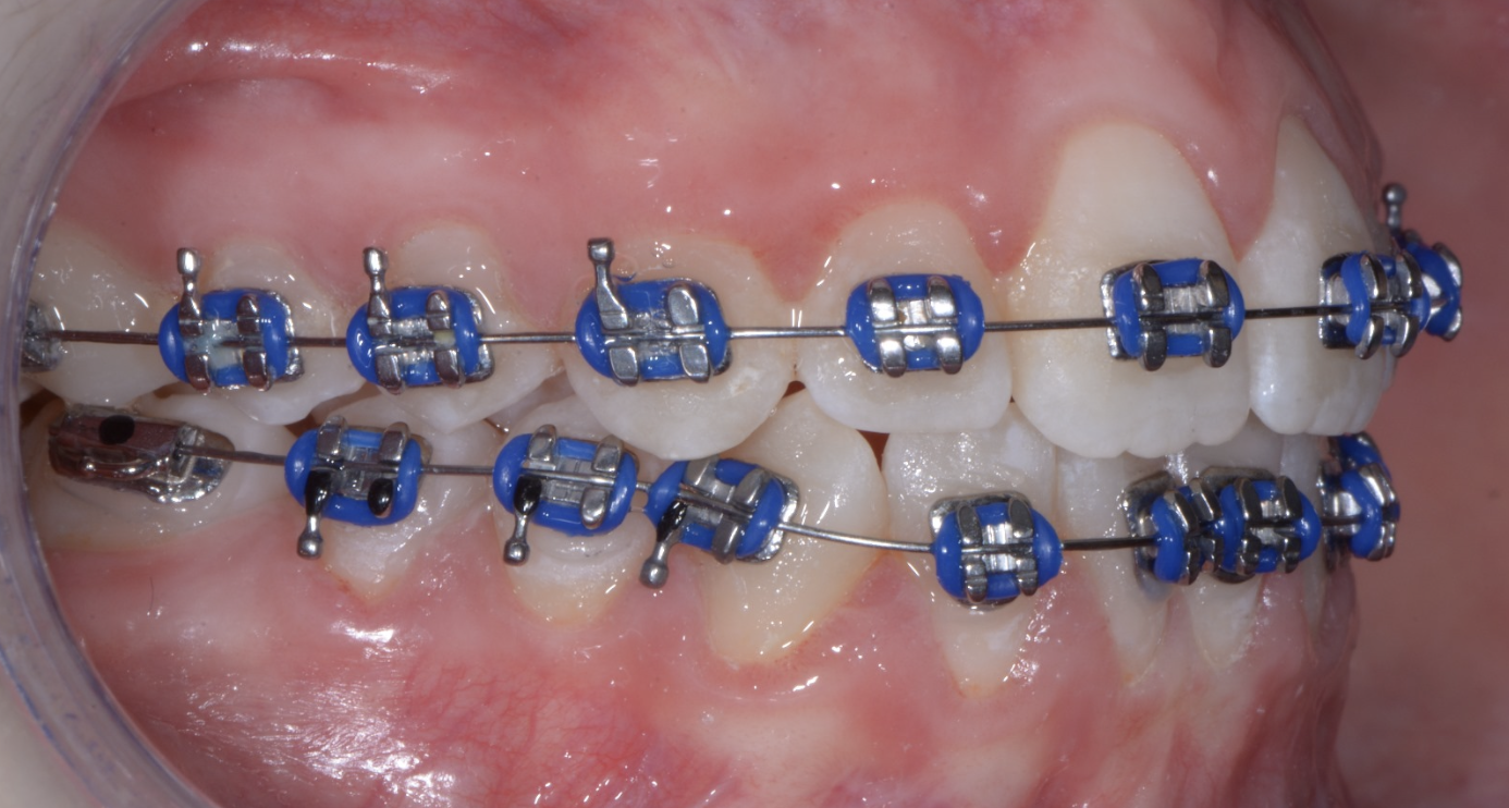 DENS AOSTA Apparecchi Tradizionali con Brackets in Metallo