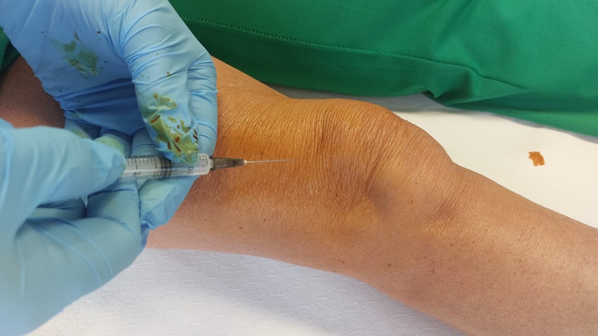 Infiltrazione di PRP - Premium medica