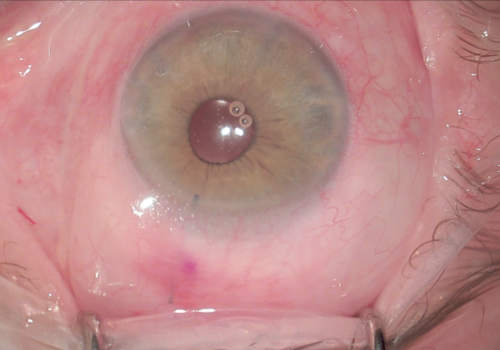L'intervento mini invasivo per il trattamento del glaucoma