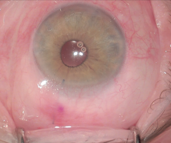 L'intervento mini invasivo per il trattamento del glaucoma