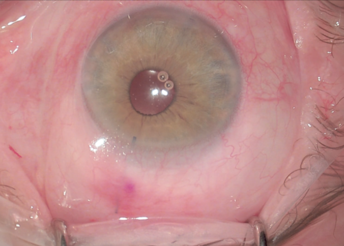 L'intervento mini invasivo per il trattamento del glaucoma