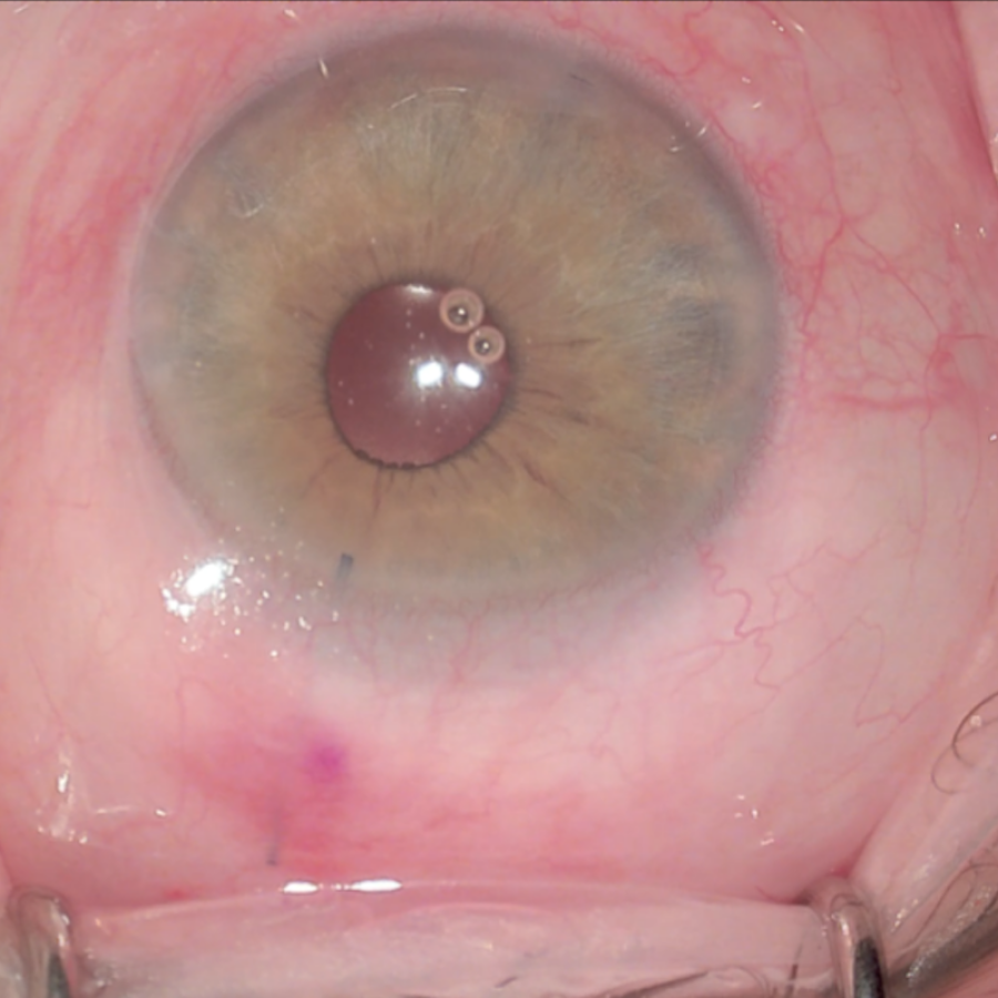 L'intervento mini invasivo per il trattamento del glaucoma