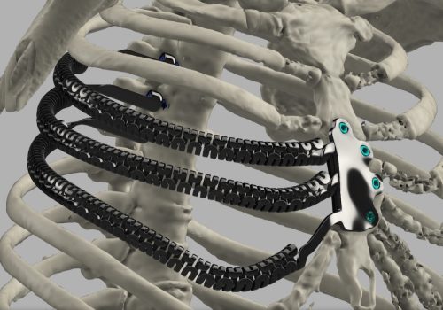 La protesi in titanio stampata in 3D