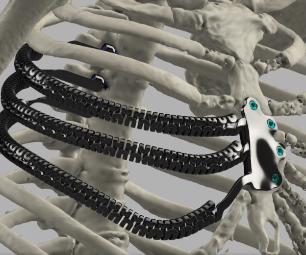 La protesi in titanio stampata in 3D
