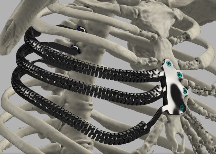La protesi in titanio stampata in 3D