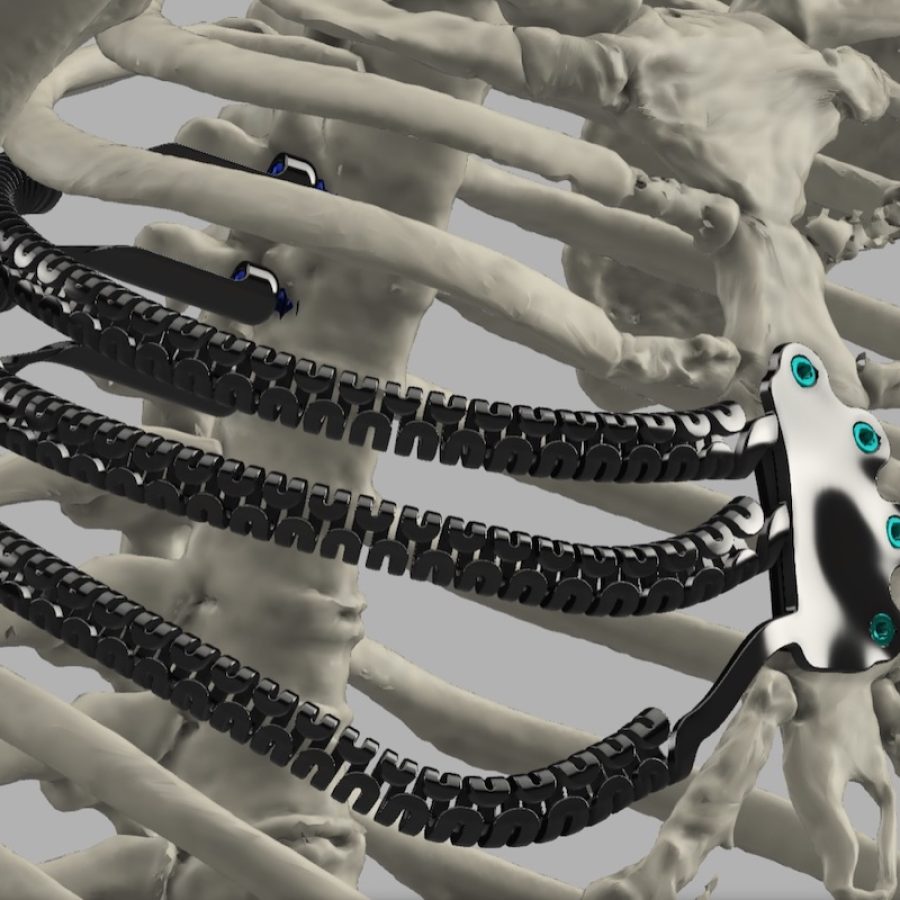La protesi in titanio stampata in 3D