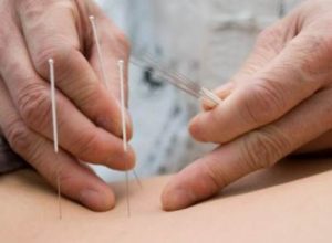 Agopuntura