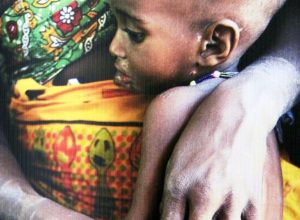 "Il cibo non basta" - Medici senza Frontiere